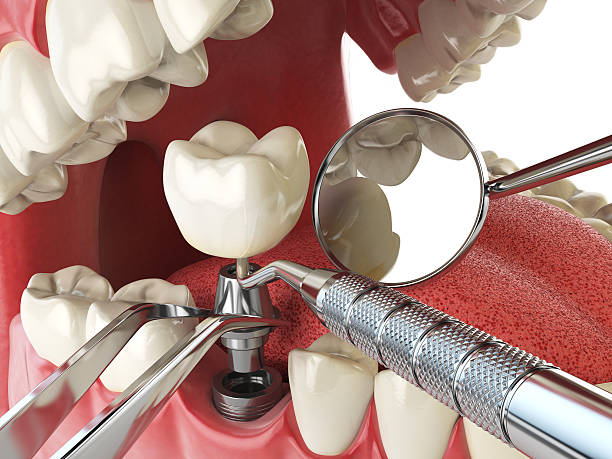 Best Urgent Care for Lost Fillings or Crowns in Watertown, FL